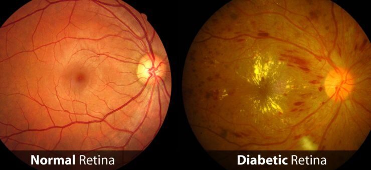 La retinopatia diabetica